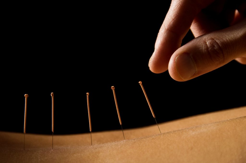 acupuncture-weybridge-surrey